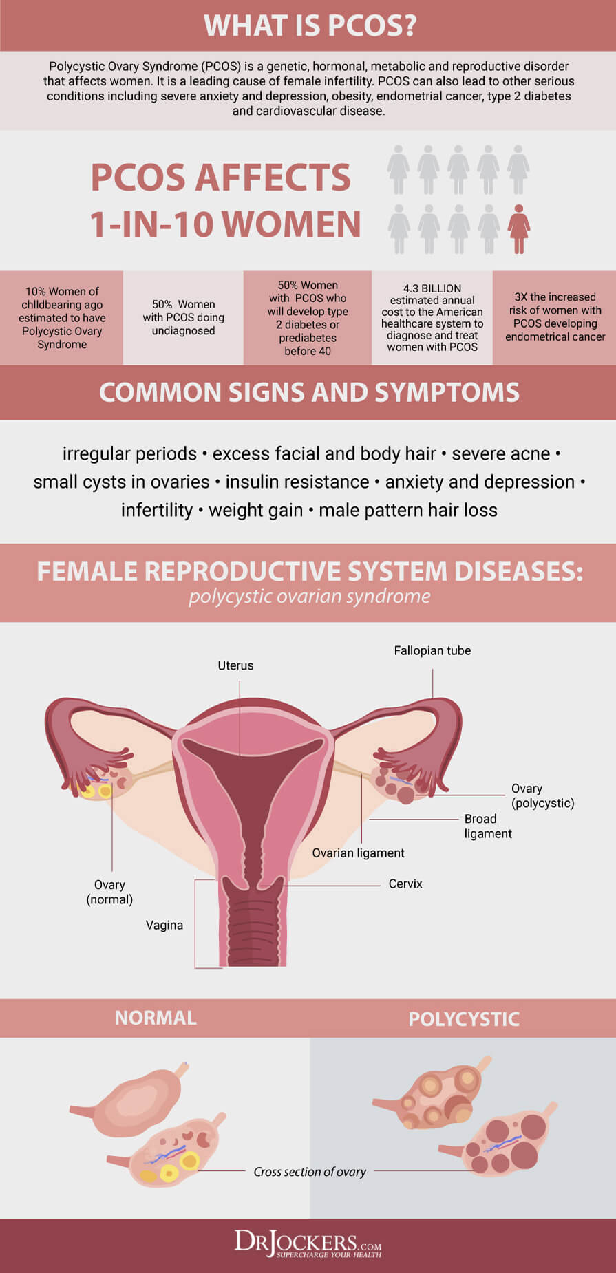 子宫内膜异位症，子宫内膜异位症:症状，原因和自然支持策略